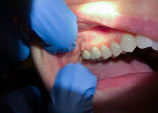 Best Dentist for Tooth Abscess  in Roanoke, VA